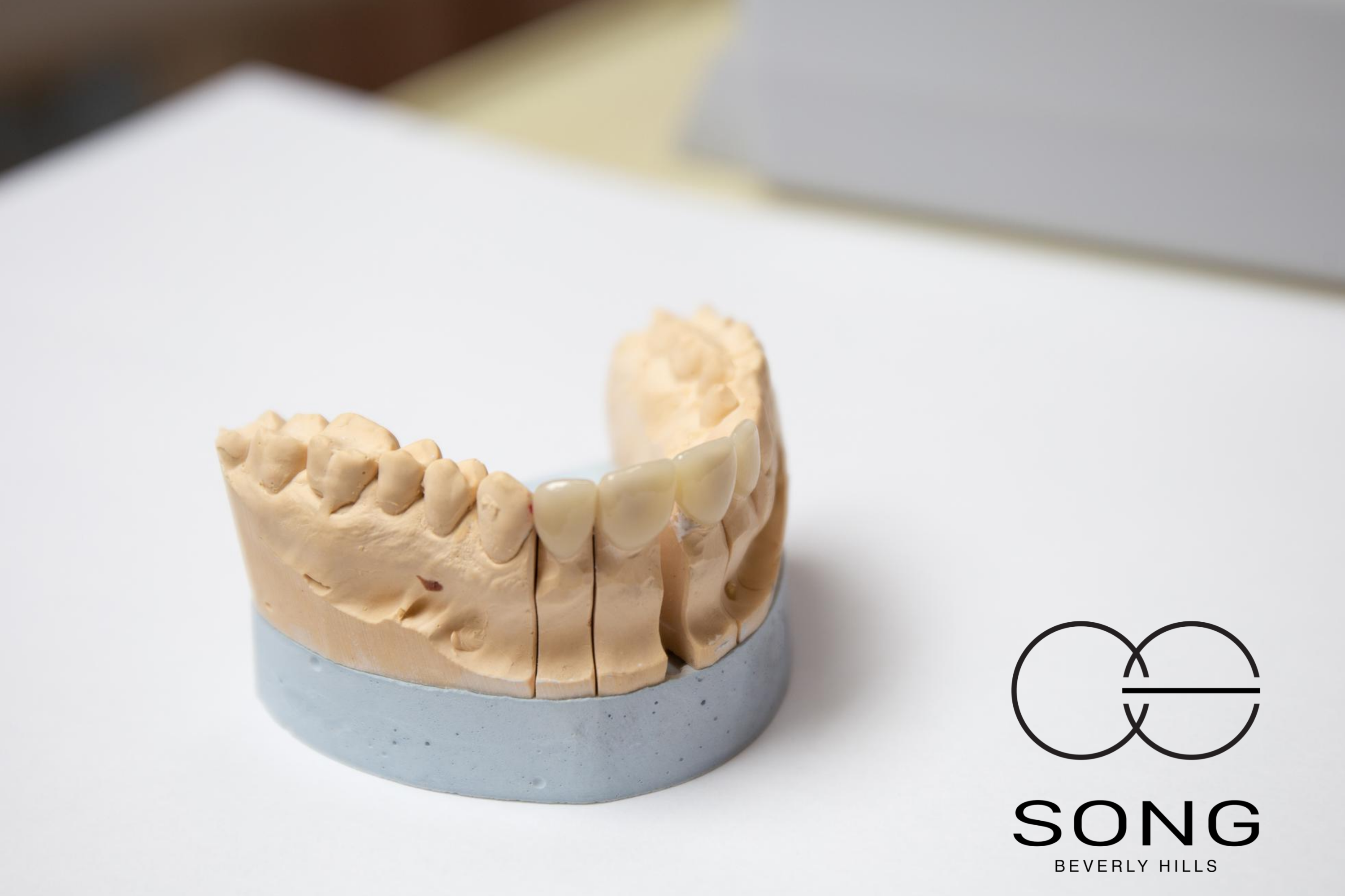 An image of lower teeth porcelain veneers